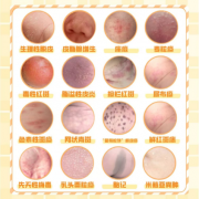 远离皮肤病,调节免疫系统